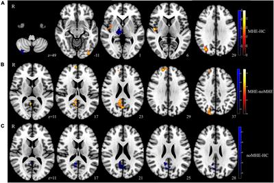 Frontiers Changes In Dynamic And Static Brain Fluctuation Distinguish Minimal Hepatic